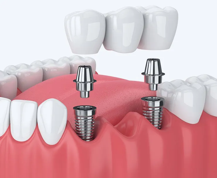 Implantologia dentale