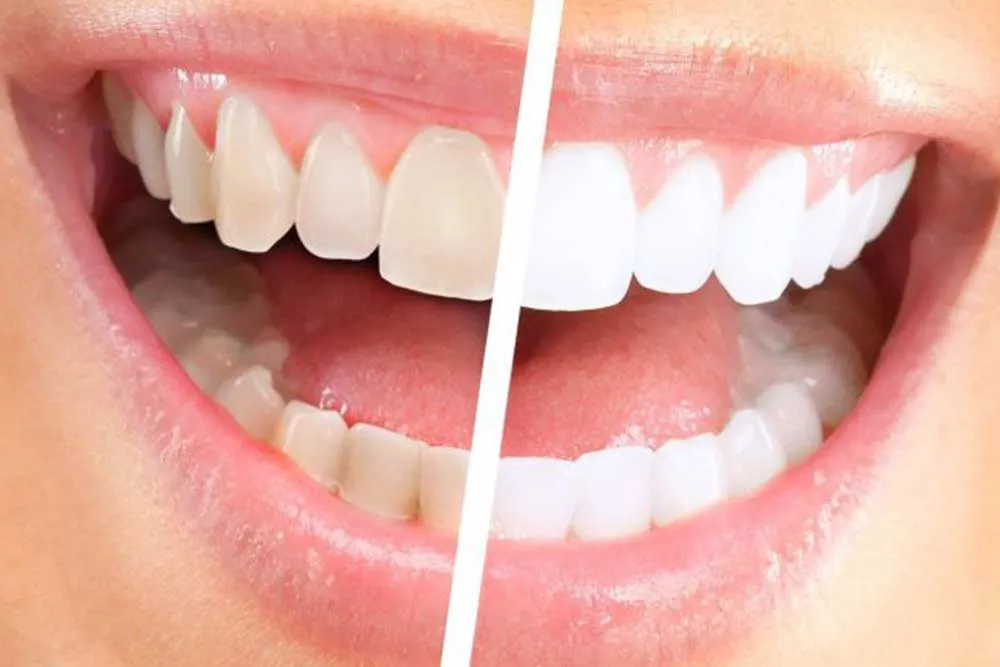 Sbiancamento dentale